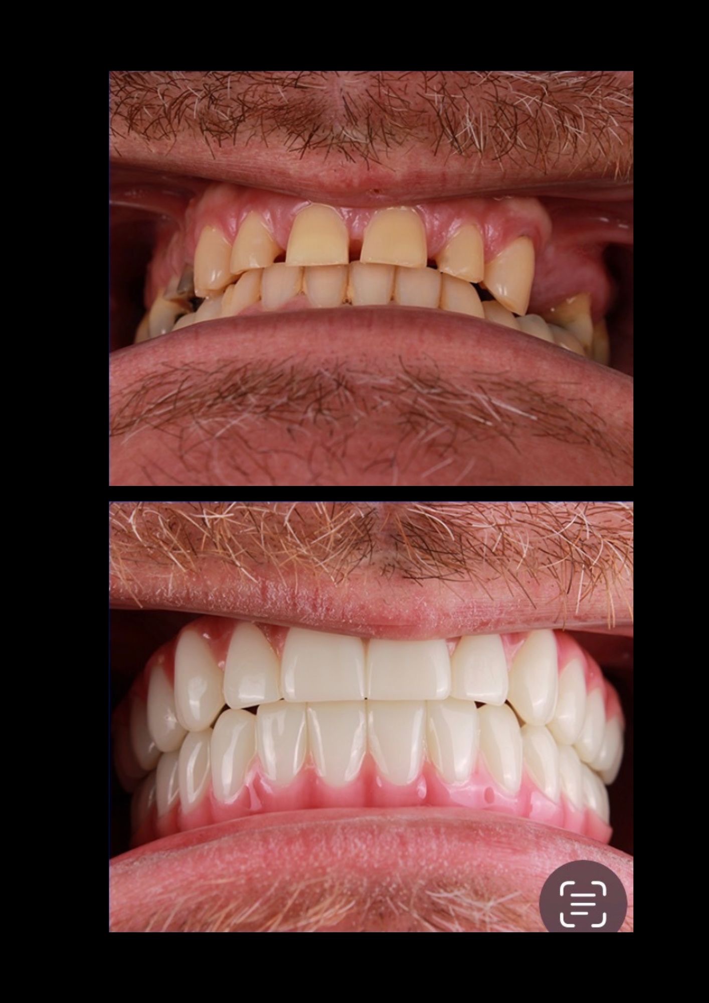 Before and after dental implants - Patient 1