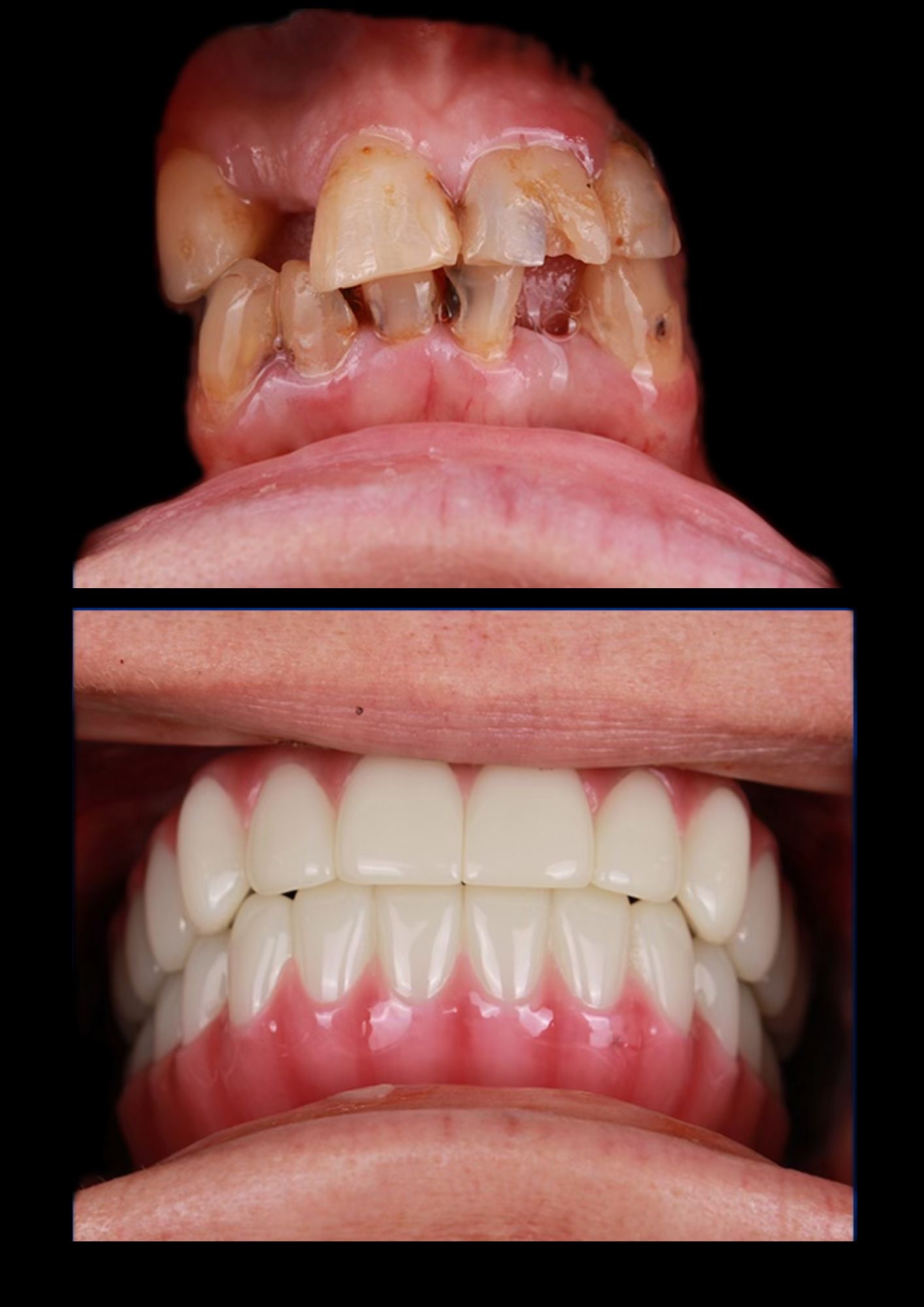 Before and after dental implants - Patient 2