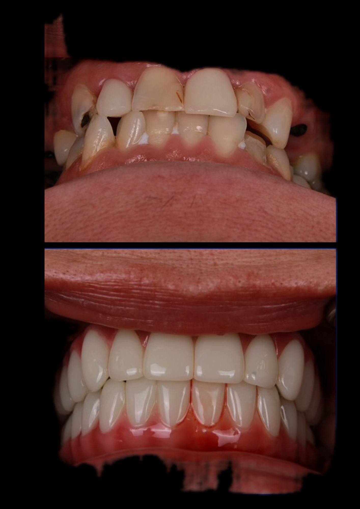 Before and after dental implants - Patient 3